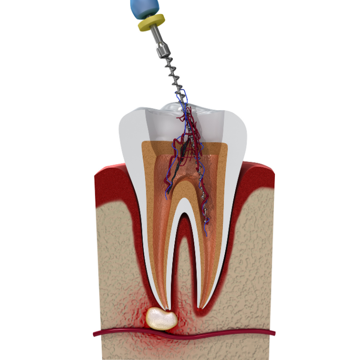 Root Canal Therapy